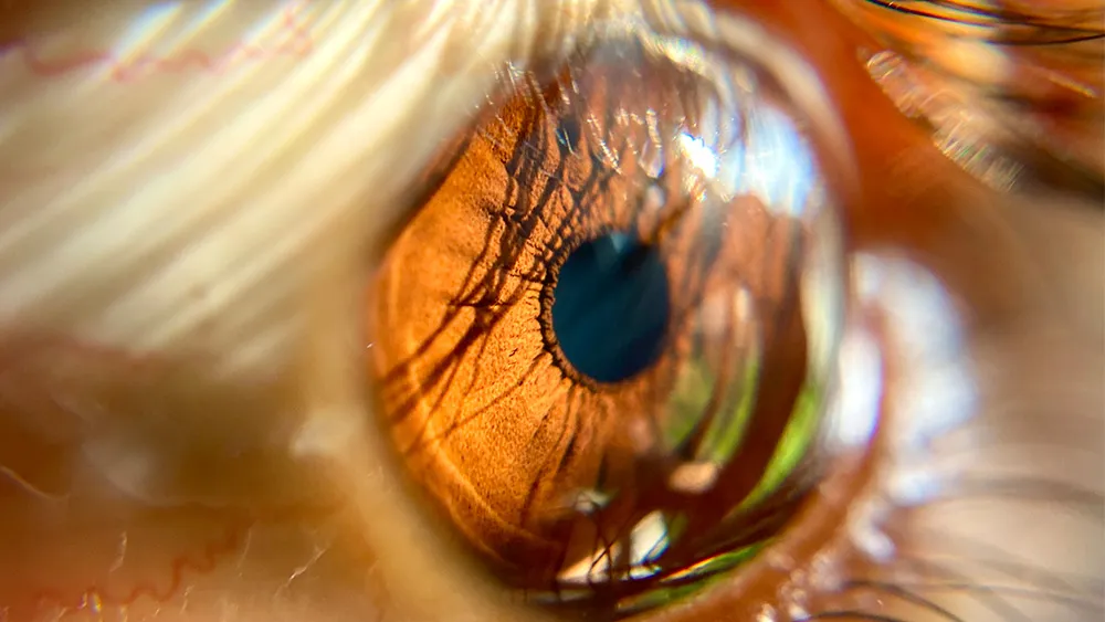 What's The Difference Between SMILE vs. LASIK